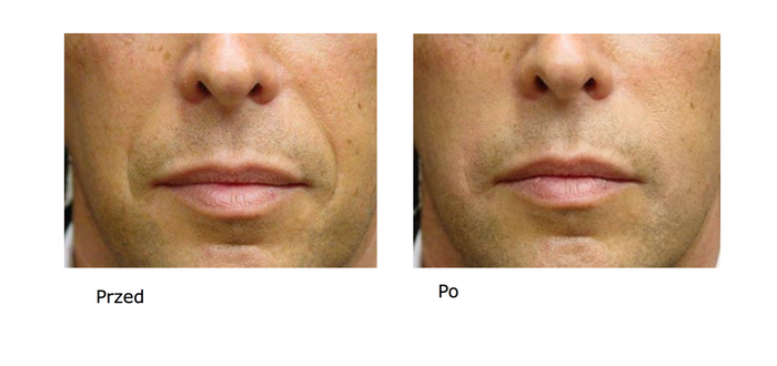 Zmarszczki nie muszą Cię blokować